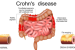 New Treatment for Crohn’s Disease