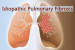 What is Idiopathic Pulmonary Fibrosis (IPF)?