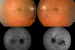 Advances in Gene Therapy for Stargardt Disease