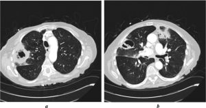 Chronic Pulmonary Aspergillosis