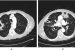 Chronic Pulmonary Aspergillosis