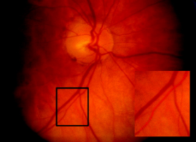 Retinal Vascular Analysis for Assessing Stroke Risk