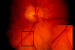 Retinal Vascular Analysis for Assessing Stroke Risk