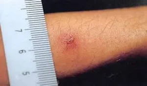 Scrub Typhus Outbreak in Tamil Nadu