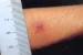 Scrub Typhus Outbreak in Tamil Nadu