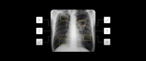 AI Tools in Tuberculosis Screening