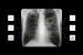 Challenges in Eliminating Tuberculosis