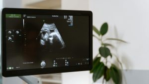 First In-Utero Treatment for Spinal Muscular Atrophy