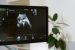 First In-Utero Treatment for Spinal Muscular Atrophy