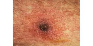 Scrub Typhus