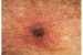 Scrub Typhus