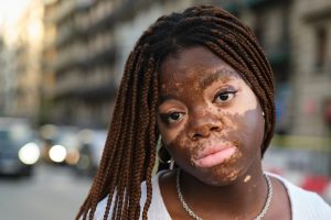 Vitiligo and Gut Bacteria