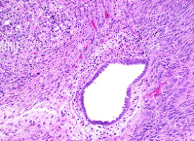 Mycetoma