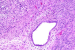 Mycetoma