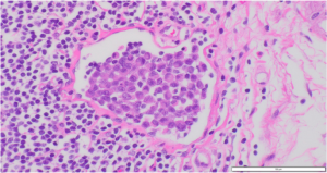 Signet Ring Cell Carcinoma