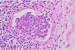 Signet Ring Cell Carcinoma