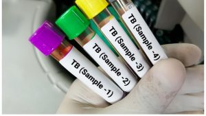 Surge in Paediatric Tuberculosis Cases in India