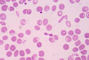 Thalassemia in India