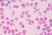 Thalassemia in India