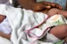 Newborn Screening for Sickle Cell Disease in India