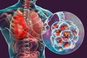 Legionnaires’ Disease