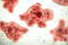 Brain-Eating Amoeba in Kerala