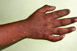 Hand, Foot and Mouth Disease Spread Among Children
