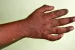 Hand, Foot and Mouth Disease Spread Among Children