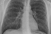 Sarcoidosis