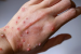 Mpox Clade Ib Spreads in Europe
