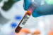 Servier India Launches Biomarker Testing Initiative for Cancer Diagnosis