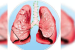 165 Gram Panchayats in Ganjam Declared TB-Free
