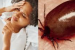 Scrub typhus surge in Andhra Pradesh: symptoms, risks and prevention