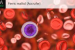 FDA Approves Accrufer for Treating Iron Deficiency in Children