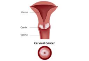 Cervical cancer: Why a largely preventable disease still kills a woman every two minutes