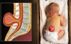 Spina Bifida Remains India’s Most Neglected Preventable Birth Defect