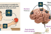IISc Launches Brain Co-Processors Moonshot for Stroke Rehabilitation