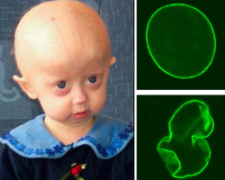Progerinin Therapy Offers Hope for Rare Progeria Disorder