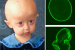 Progerinin Therapy Offers Hope for Rare Progeria Disorder