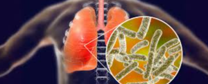 Legionnaires’ Disease Surge Raises Urban Water Safety Concerns