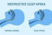 Sleep Apnea Raises Cardiovascular Death Risk by 71%