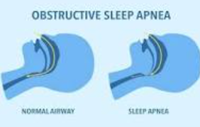 Sleep Apnea Raises Cardiovascular Death Risk by 71%