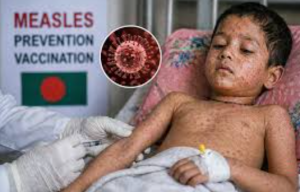 बांग्लादेश में खसरा प्रकोप से 336 बच्चों की मौत