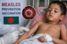 Bangladesh Measles Outbreak