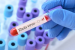 WHO Lists First Ebola Bundibugyo Diagnostic Test for Emergency Use