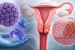 SHetA2 Therapy for HPV-Related Cervical Disease